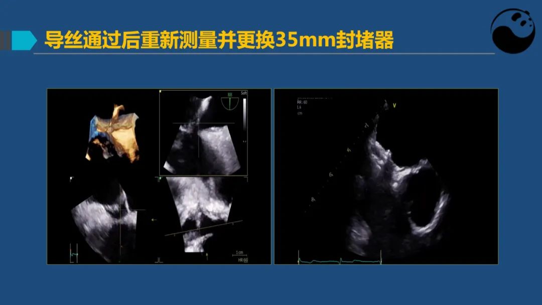 卵圆孔未闭（PFO）形态学测量思考