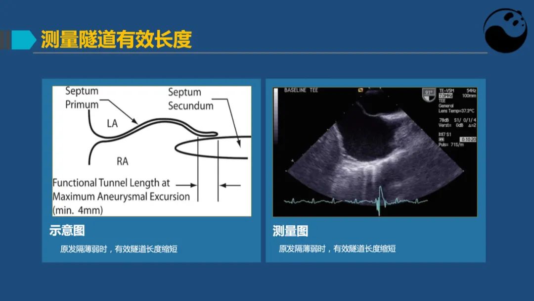 卵圆孔未闭（PFO）形态学测量思考