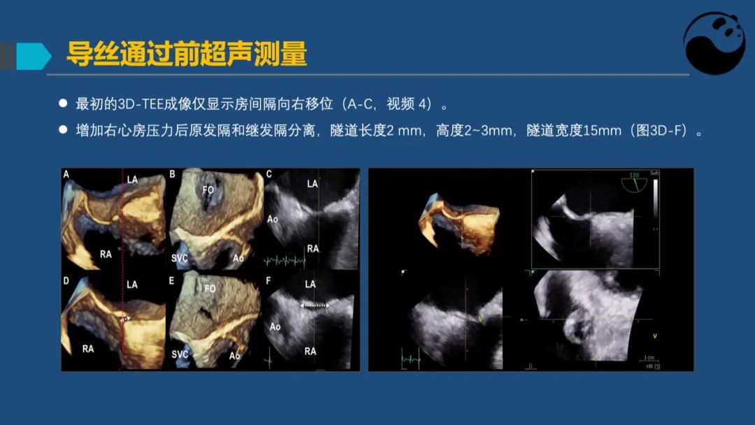 卵圆孔未闭（PFO）形态学测量思考