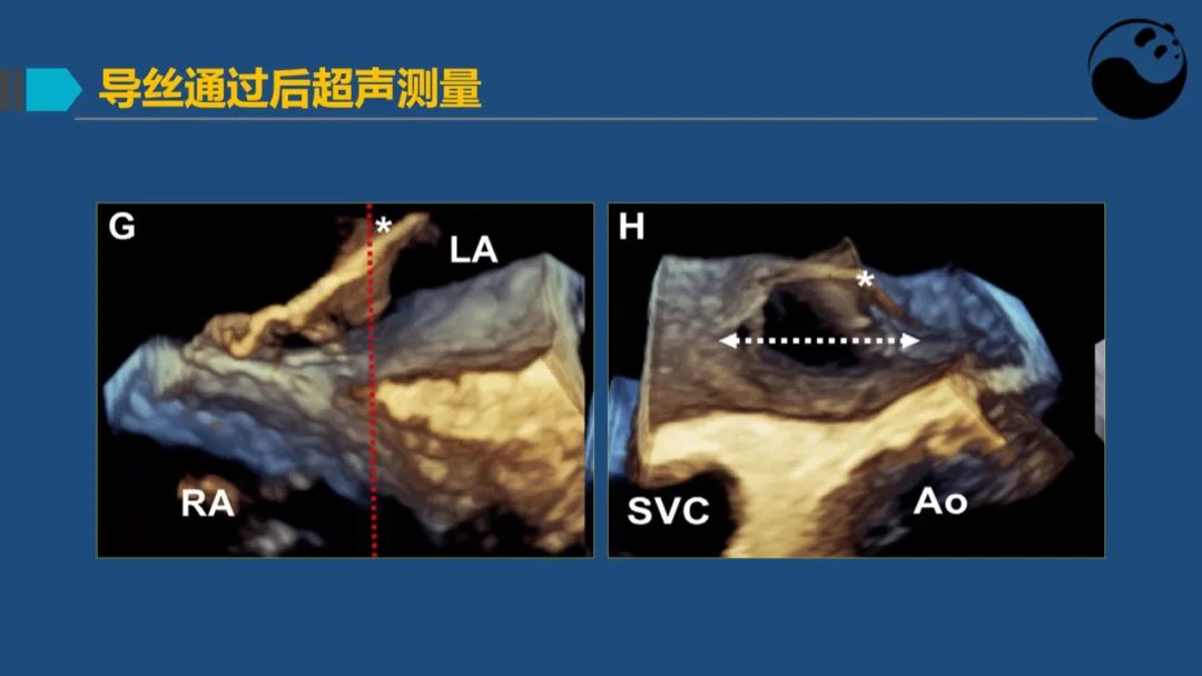 卵圆孔未闭（PFO）形态学测量思考