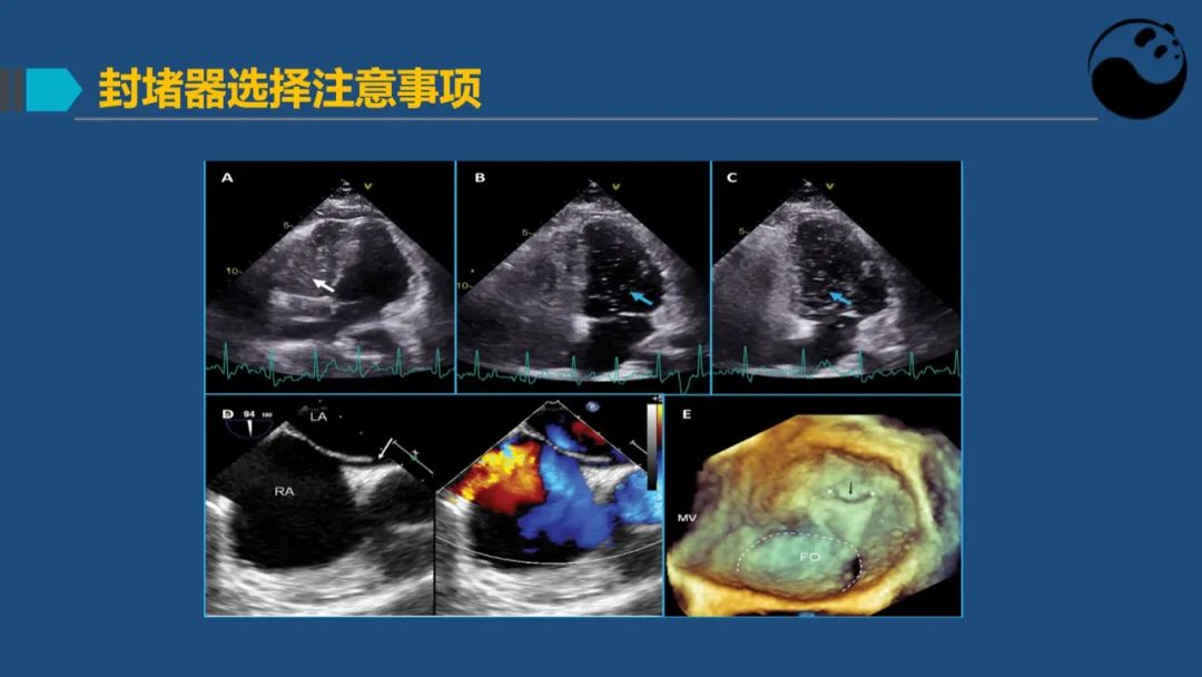 卵圆孔未闭（PFO）形态学测量思考