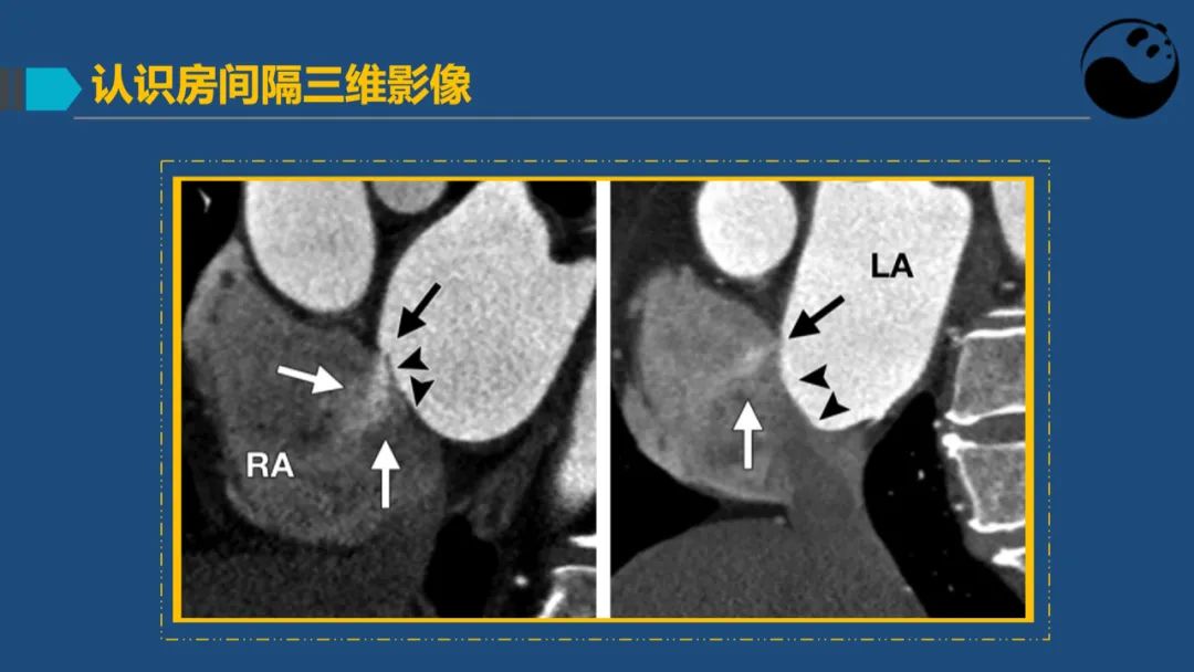 卵圆孔未闭（PFO）形态学测量思考