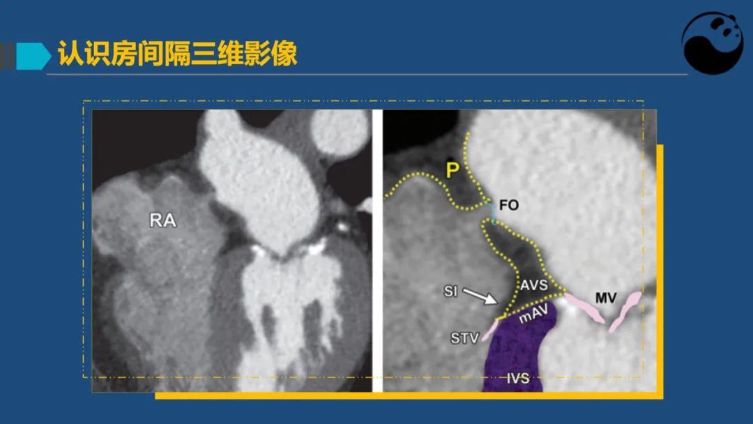 卵圆孔未闭（PFO）形态学测量思考