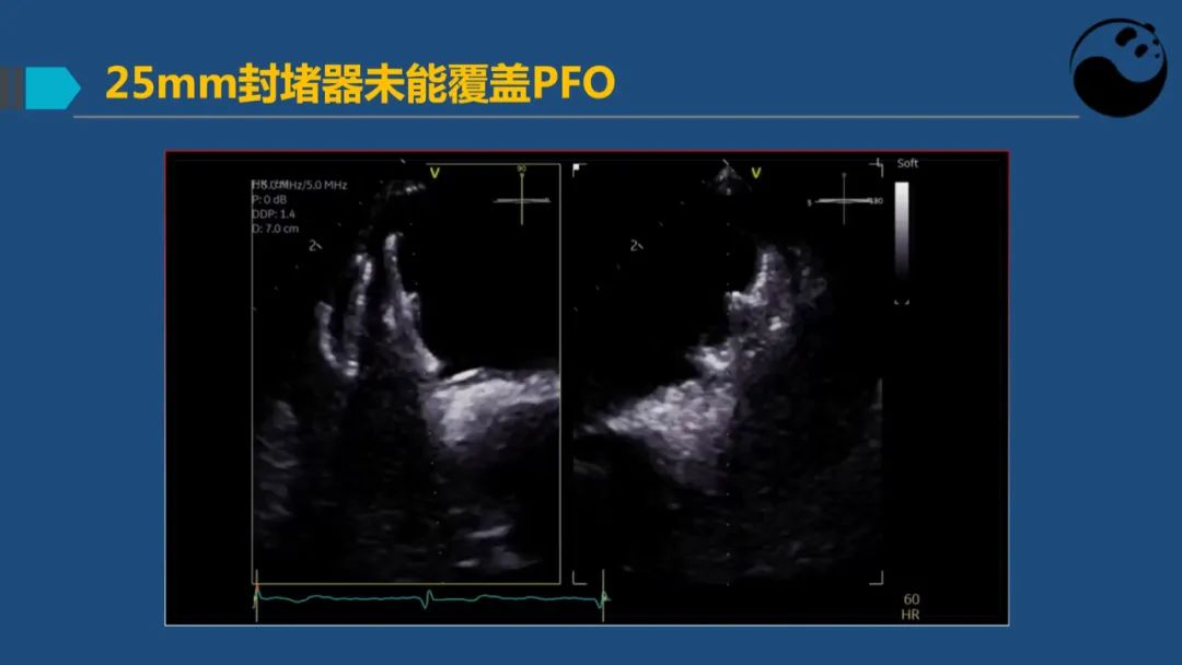 卵圆孔未闭（PFO）形态学测量思考