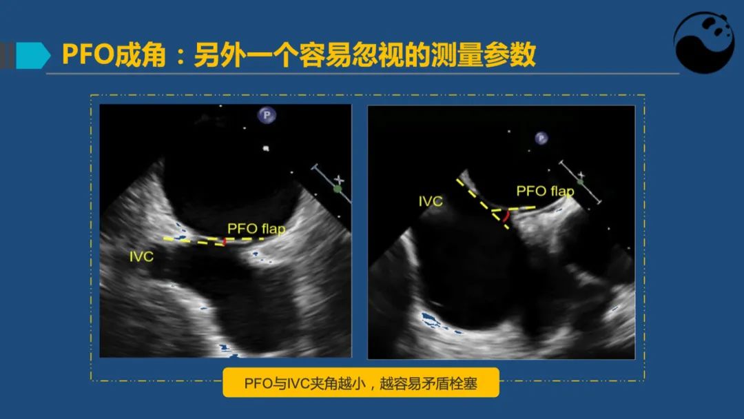 卵圆孔未闭（PFO）形态学测量思考