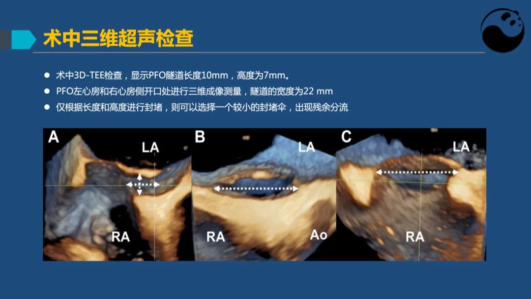 卵圆孔未闭（PFO）形态学测量思考