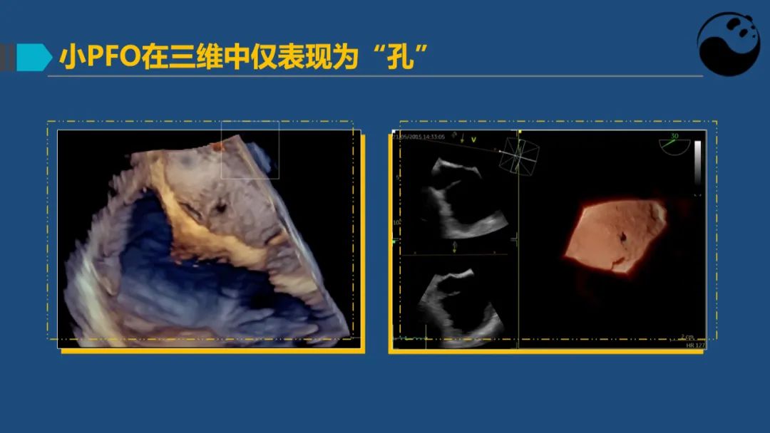 卵圆孔未闭（PFO）形态学测量思考