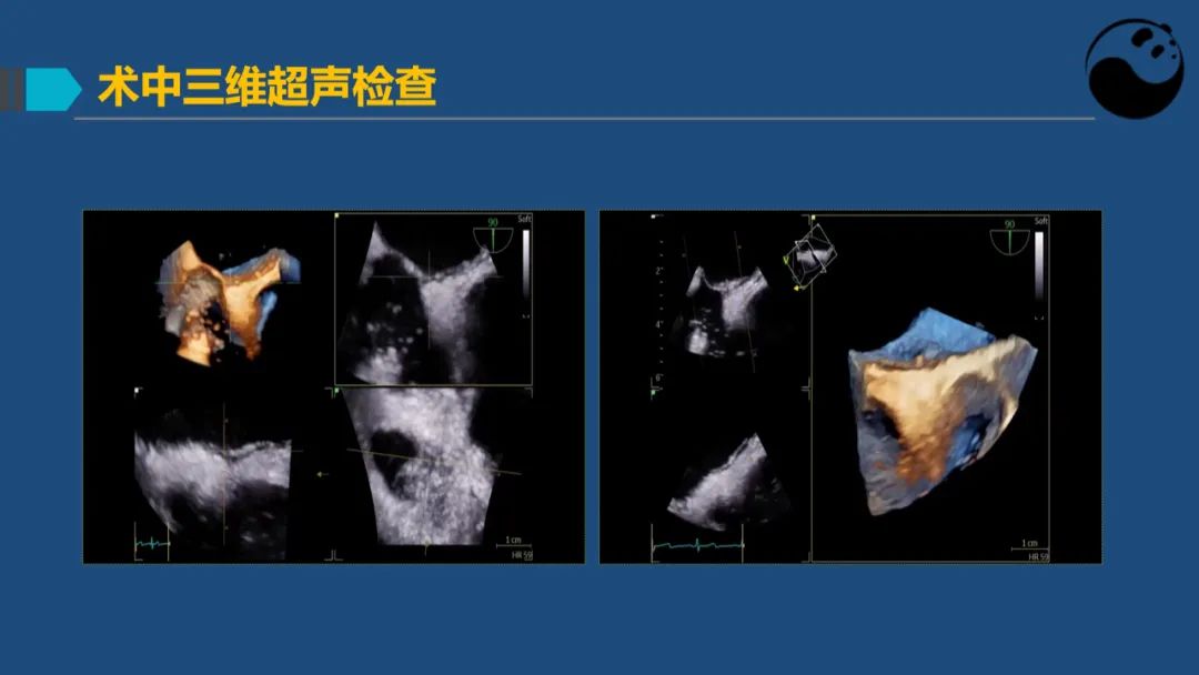 卵圆孔未闭（PFO）形态学测量思考