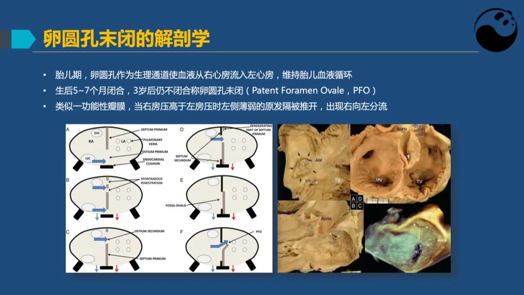 卵圆孔未闭（PFO）形态学测量思考