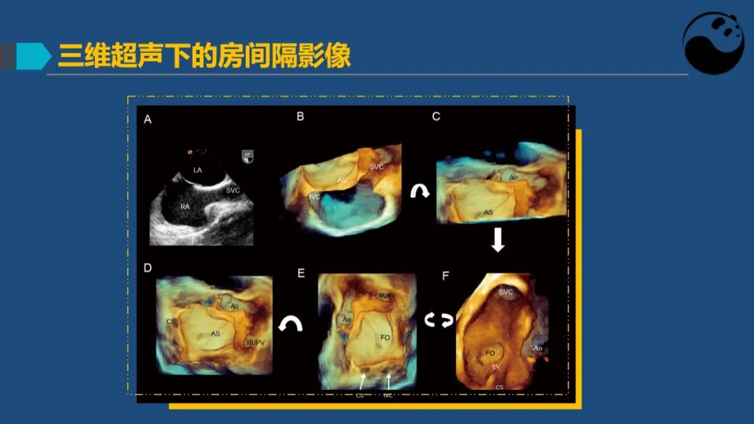 卵圆孔未闭（PFO）形态学测量思考