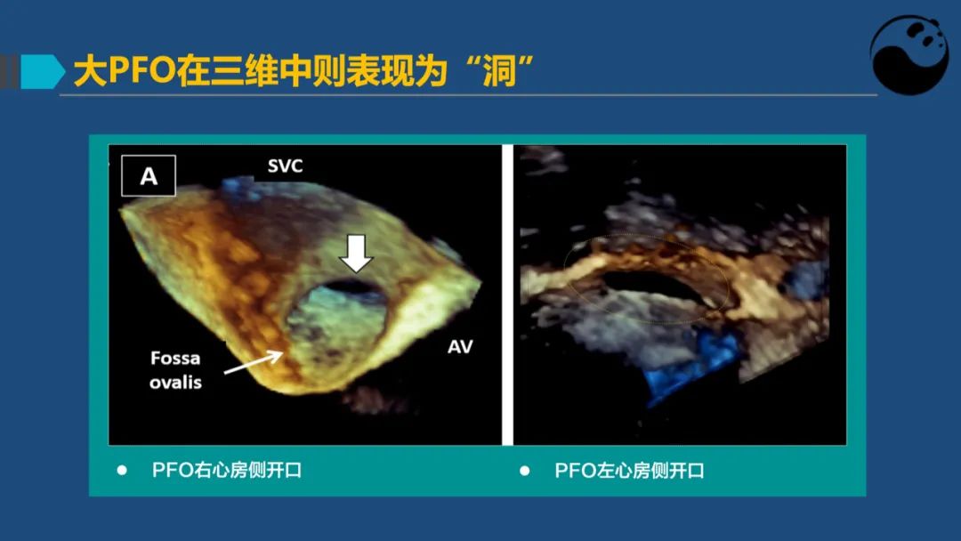 卵圆孔未闭（PFO）形态学测量思考