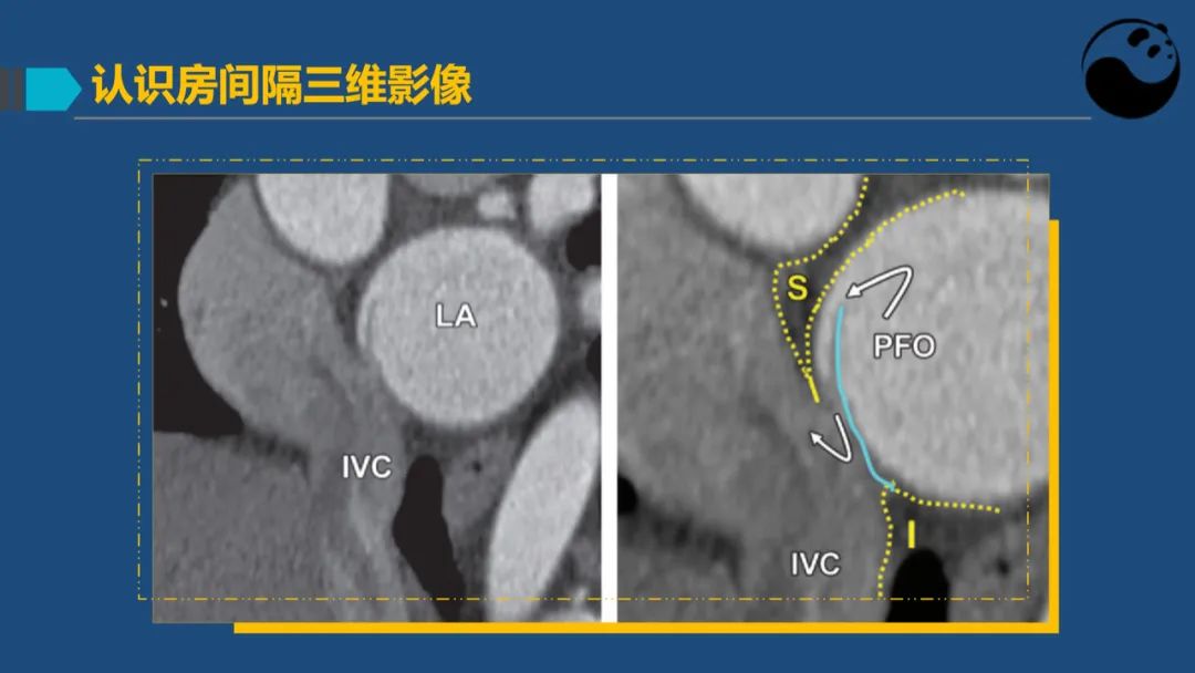 卵圆孔未闭（PFO）形态学测量思考