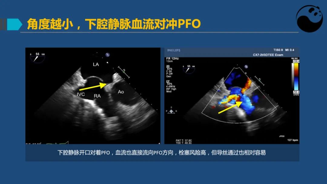 卵圆孔未闭（PFO）形态学测量思考