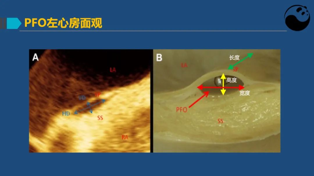 卵圆孔未闭（PFO）形态学测量思考