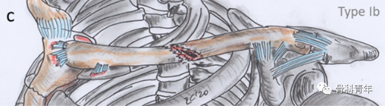 锁骨骨-韧带联合伤及其分型系统