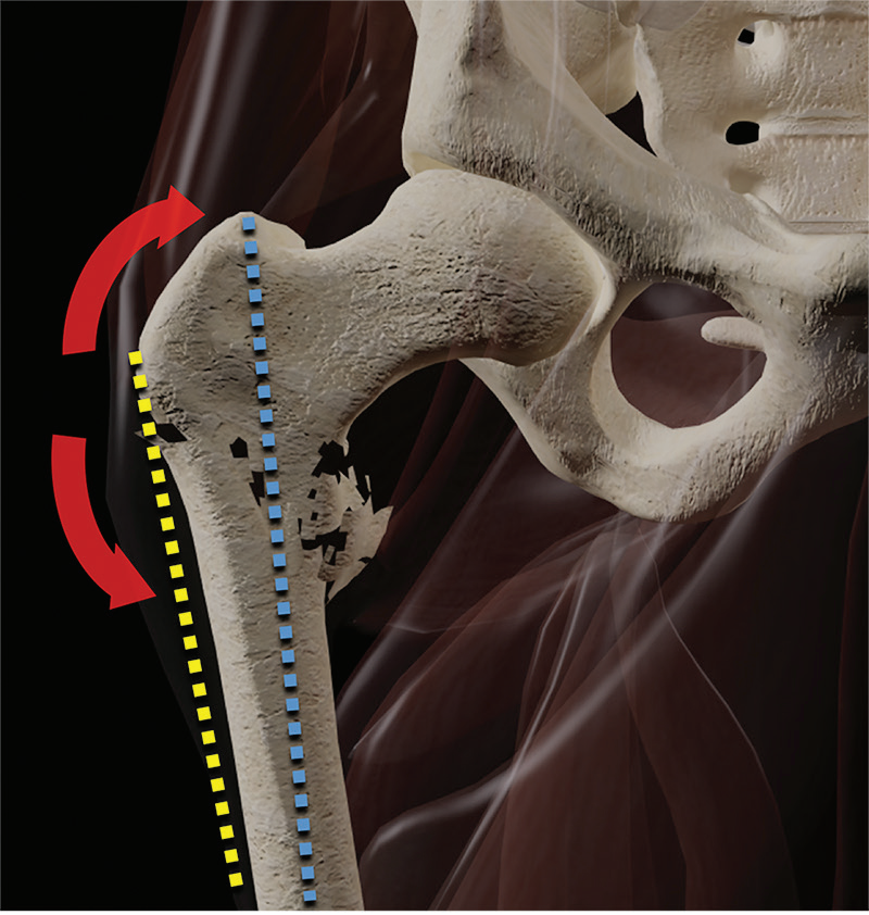 股骨近端骨折：每一个骨科医生都应该知道的要点