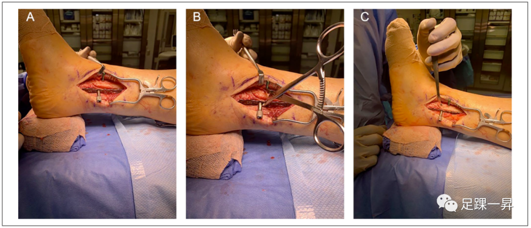 FAI手术技巧：严重骨量减少时Weber B型外踝骨折的复位技术- 好医术早读 