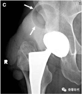 全髋关节置换术中内衬脱位的影像学评价