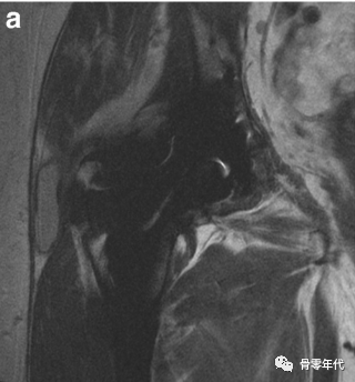 全髋关节置换术中内衬脱位的影像学评价