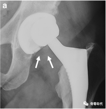 全髋关节置换术中内衬脱位的影像学评价