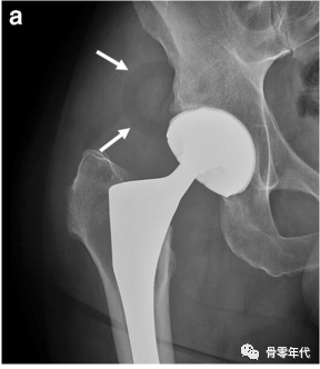 全髋关节置换术中内衬脱位的影像学评价