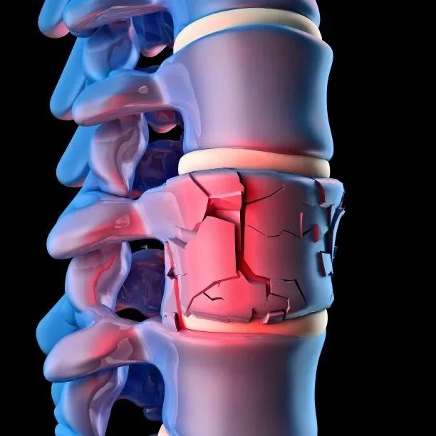 经皮椎体成形术（PVP）之经横突-椎弓根外侧入路