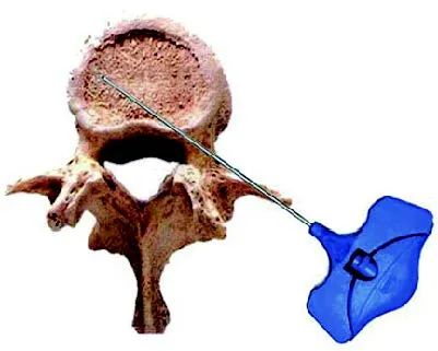 经皮椎体成形术（PVP）之经横突-椎弓根外侧入路