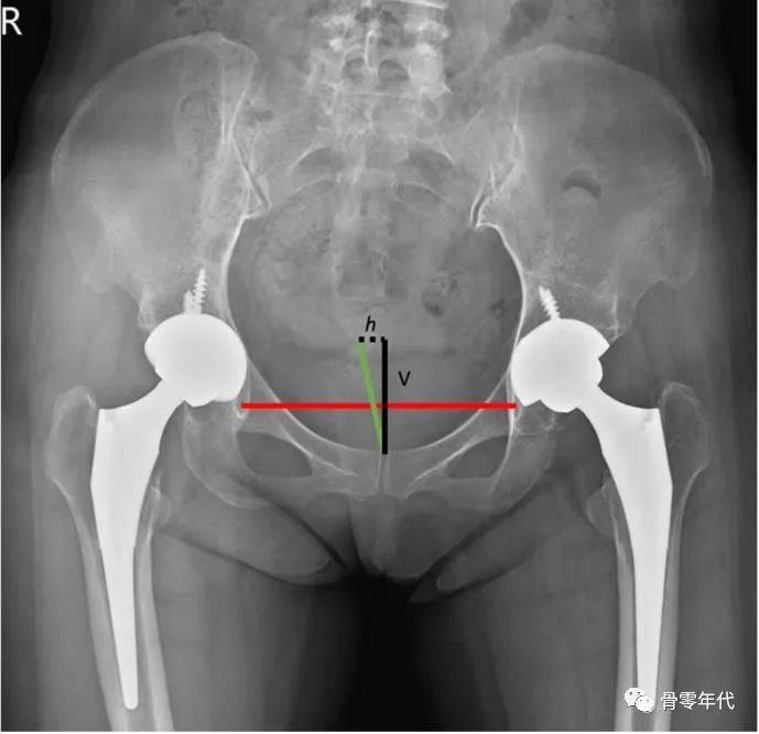 髋关节置换术后x线片冠状面骨盆旋转程度