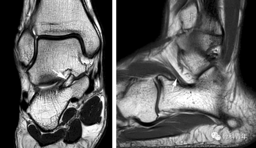 骨科影像｜跗骨窦解剖与14例跗骨窦区病变的MR表现
