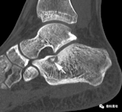 骨科影像｜跗骨窦解剖与14例跗骨窦区病变的MR表现