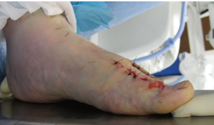 图文细说足踝外科医生的必修课——拇外翻的诊治