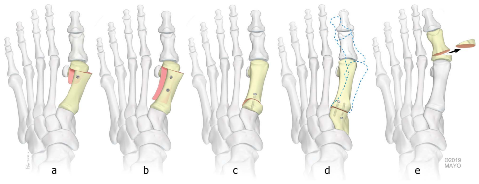 图文细说足踝外科医生的必修课——拇外翻的诊治