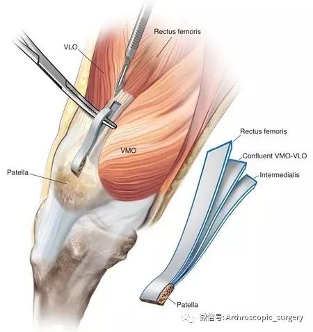 自体股四头肌重建前交叉韧带！各方面俱佳，你会用吗？