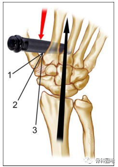 从损伤机制、分型再认识大多角骨骨折