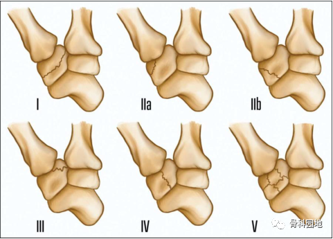 从损伤机制、分型再认识大多角骨骨折
