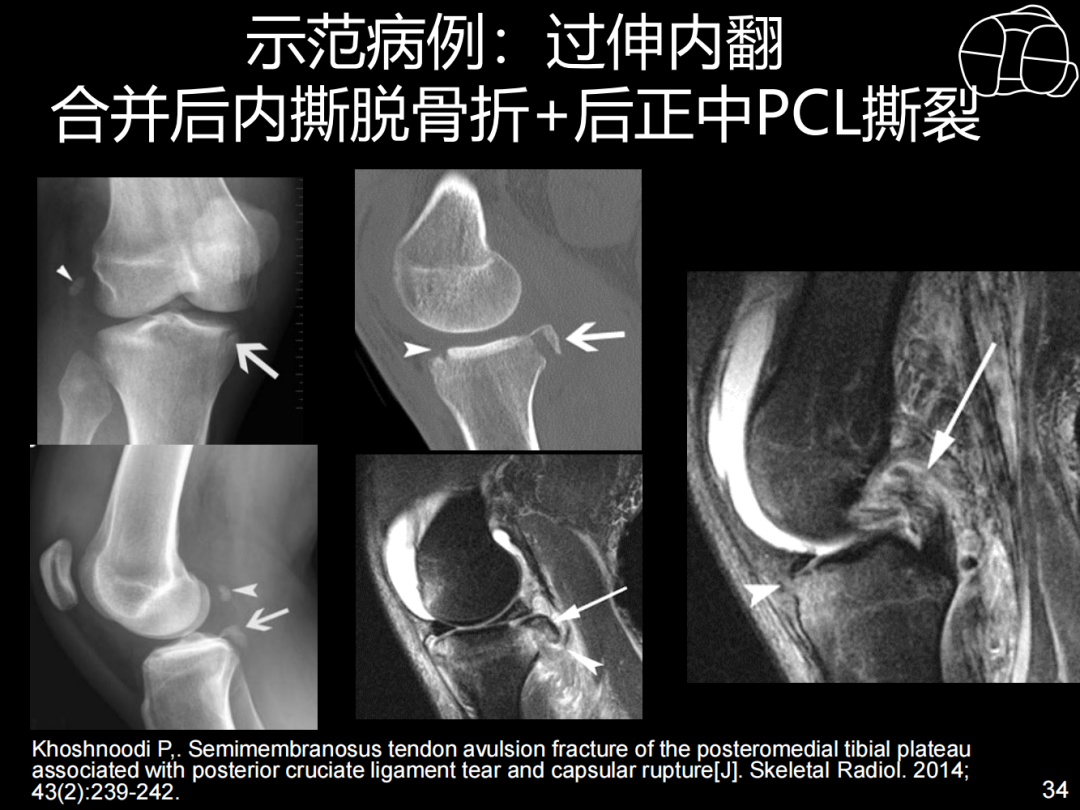 过伸型胫骨平台骨折