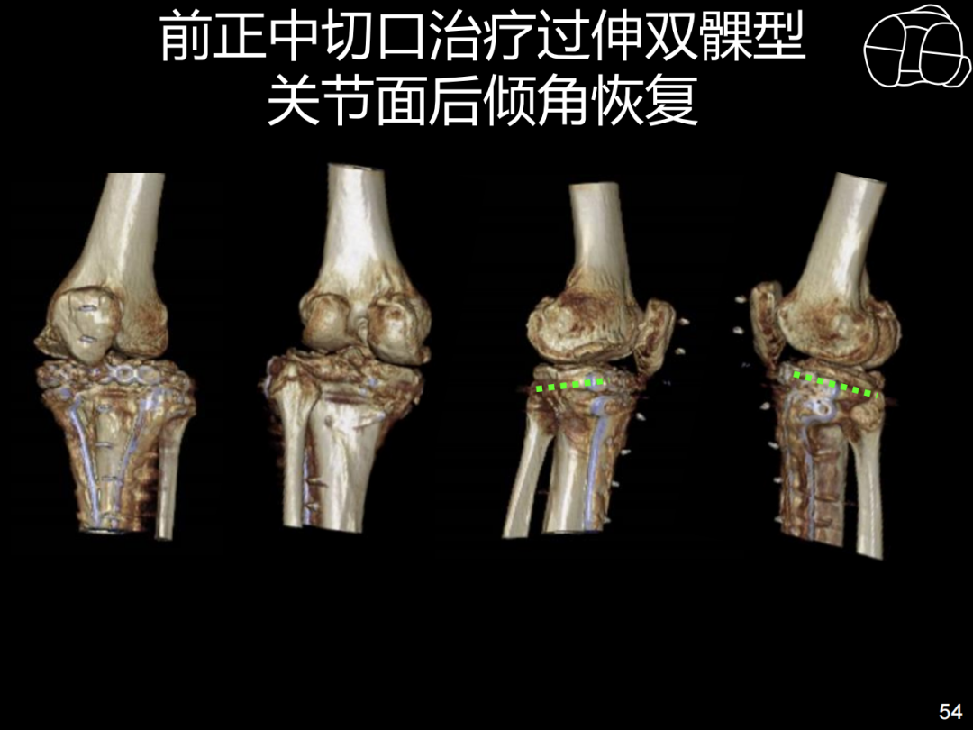 过伸型胫骨平台骨折