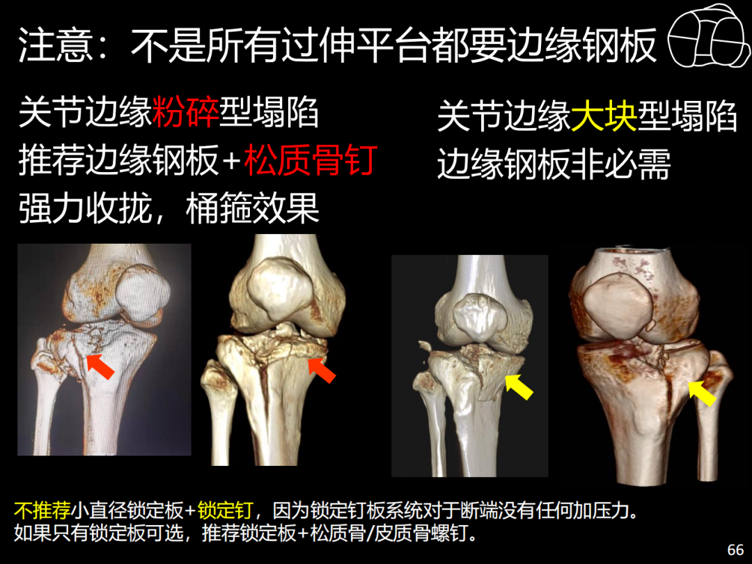 过伸型胫骨平台骨折