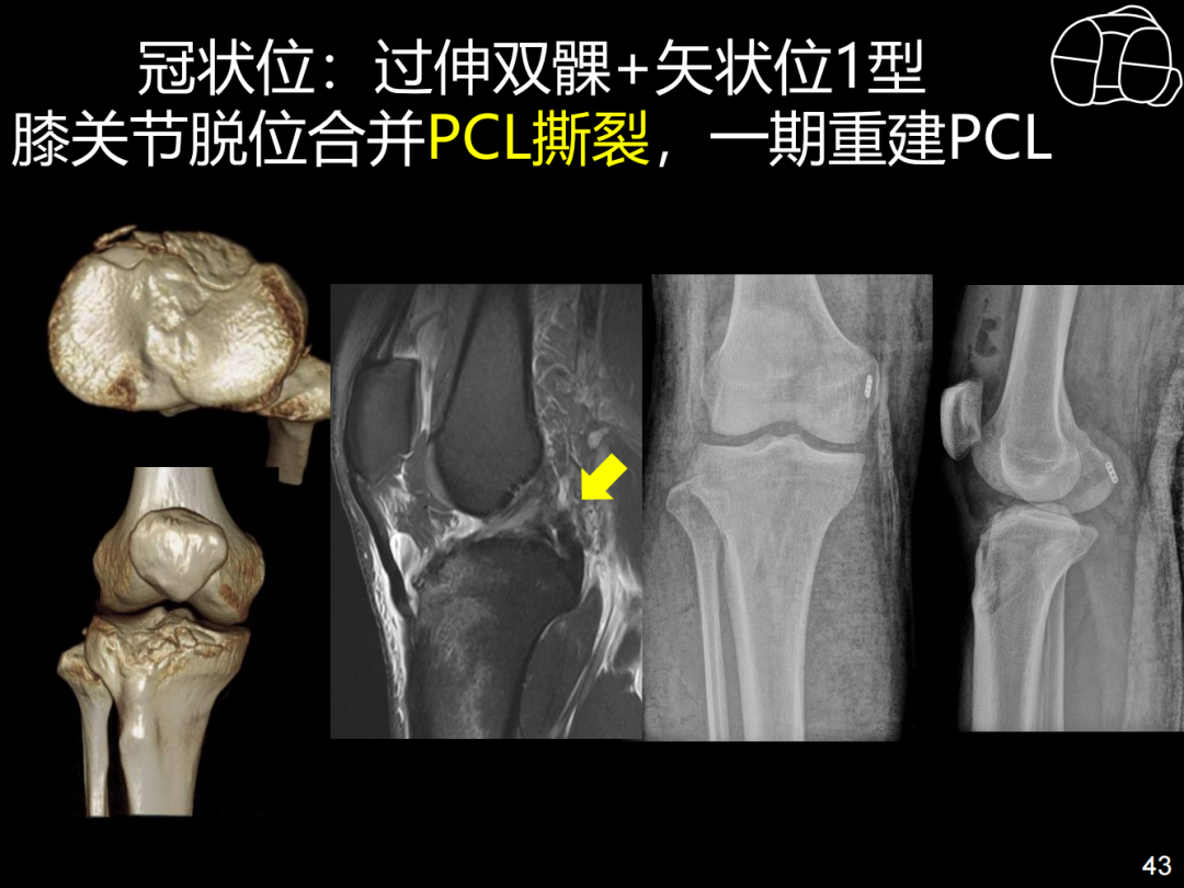 过伸型胫骨平台骨折