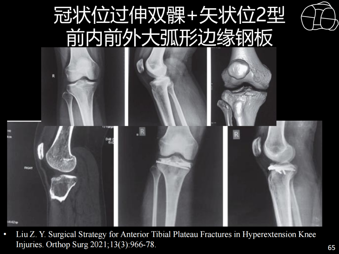 过伸型胫骨平台骨折