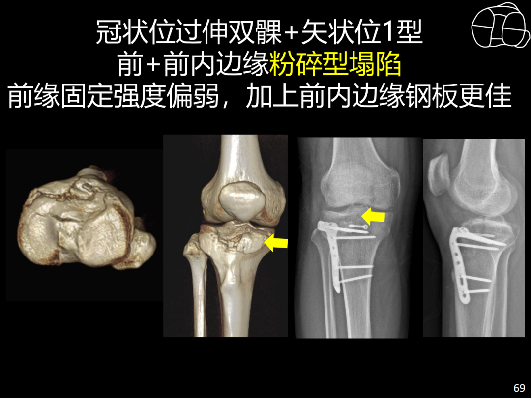 过伸型胫骨平台骨折