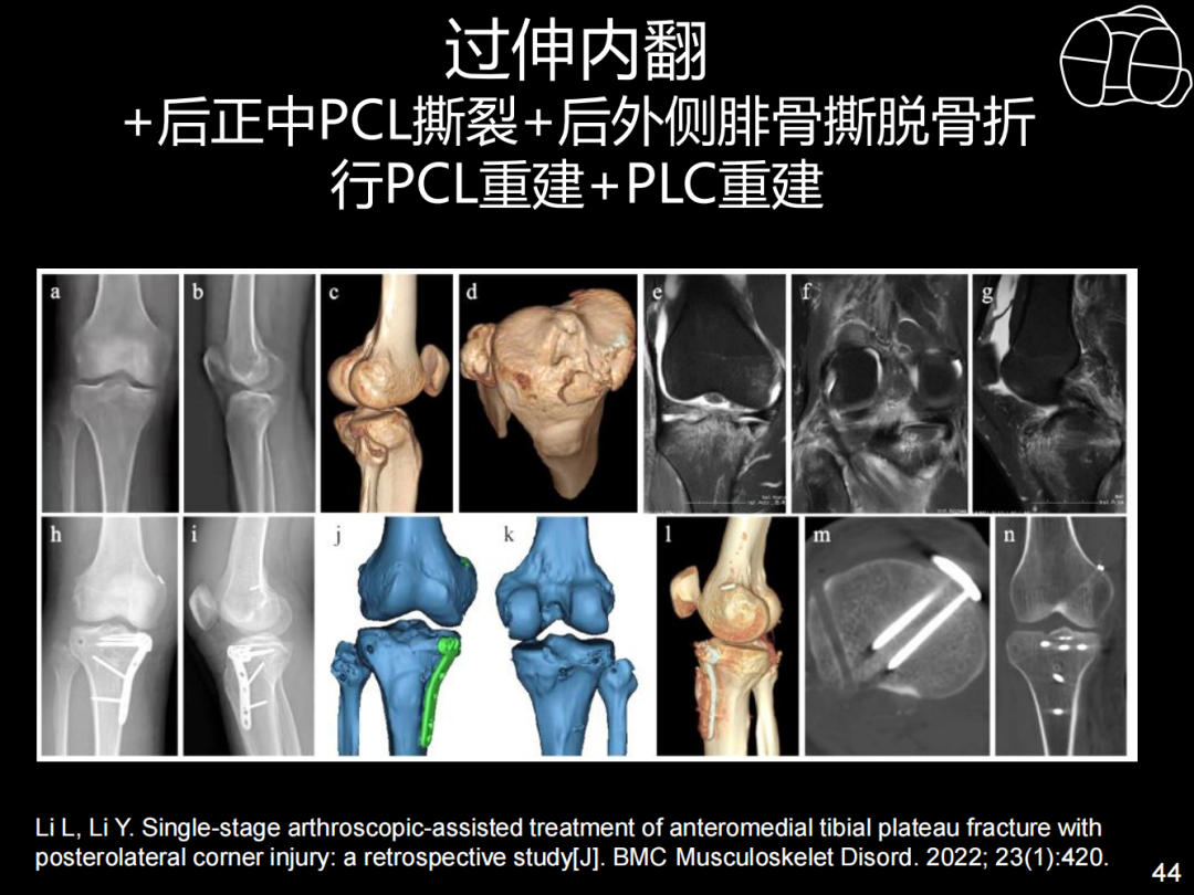 过伸型胫骨平台骨折