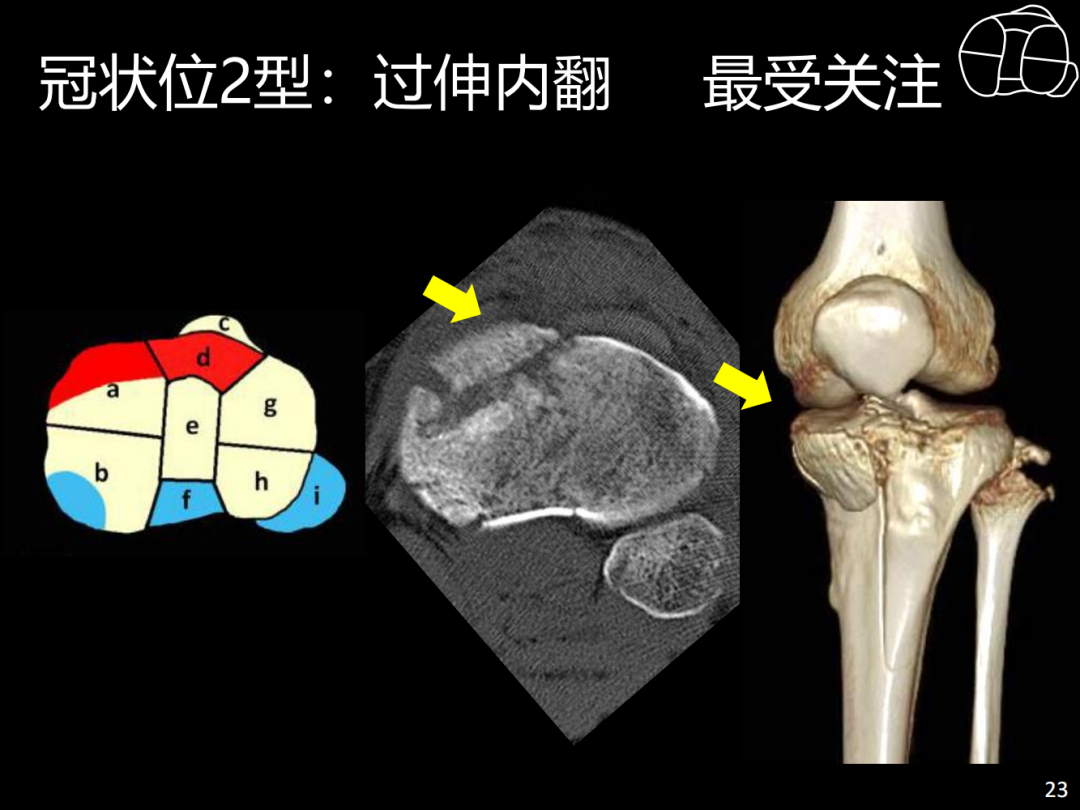 过伸型胫骨平台骨折