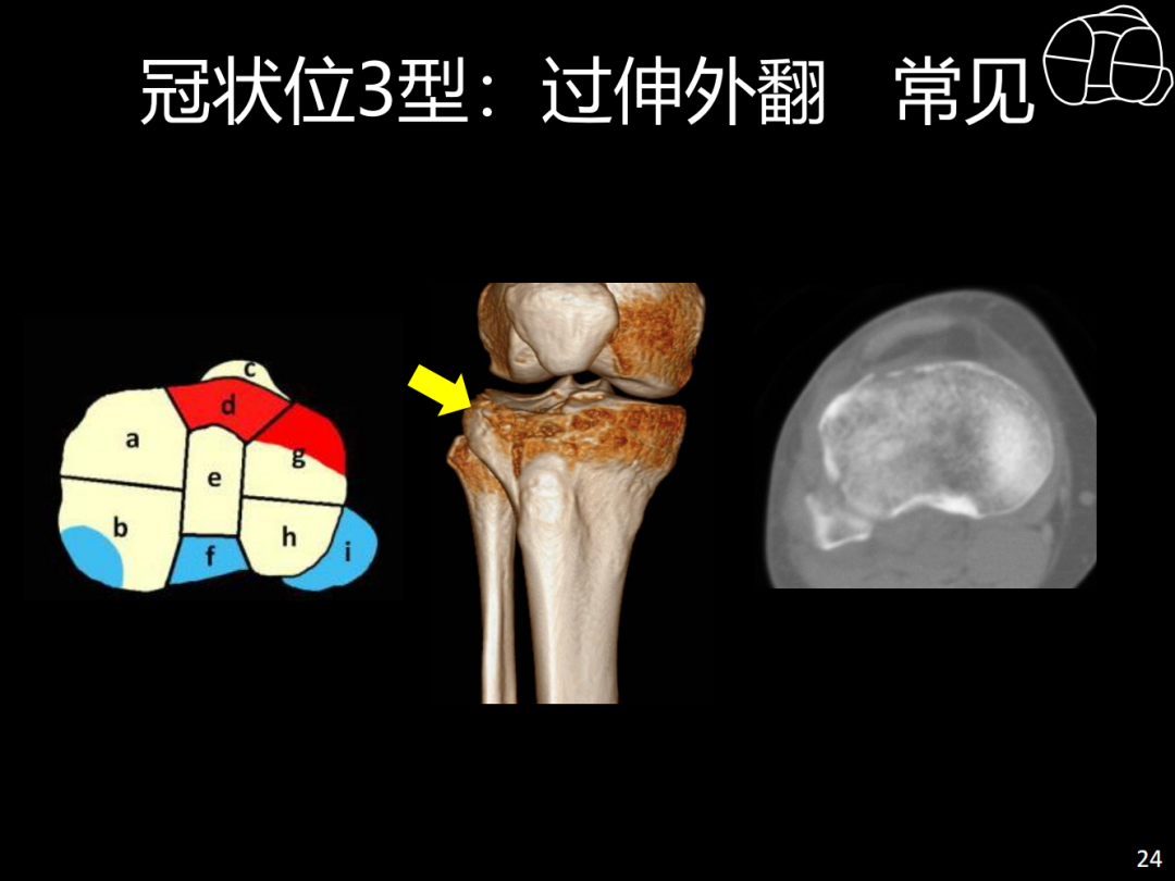 过伸型胫骨平台骨折