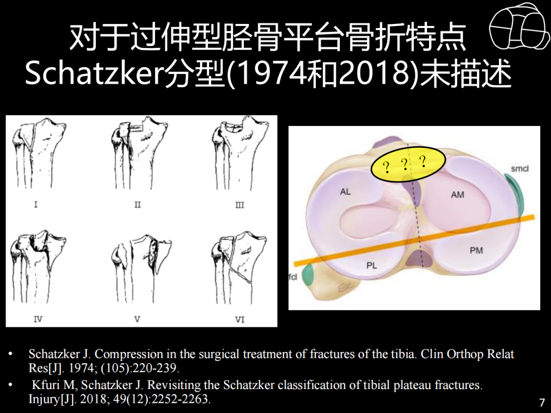 过伸型胫骨平台骨折