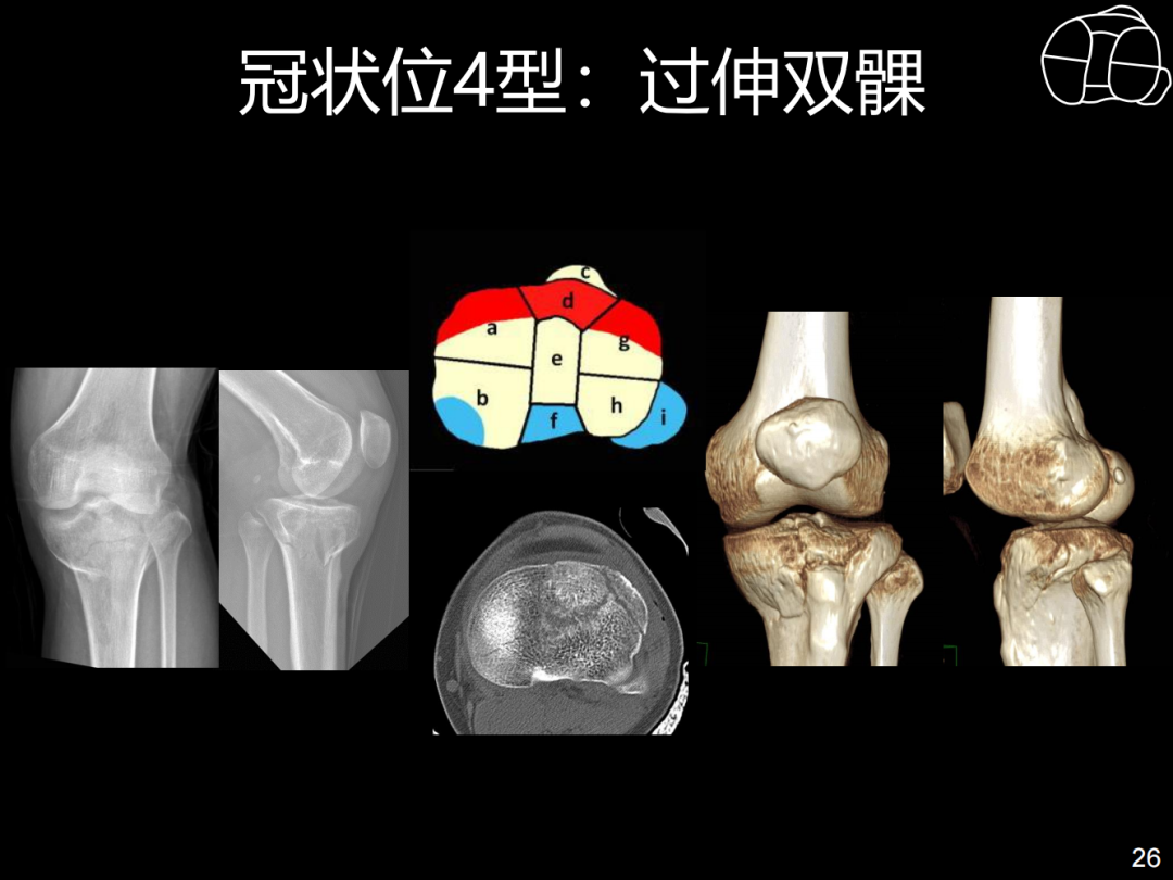 过伸型胫骨平台骨折