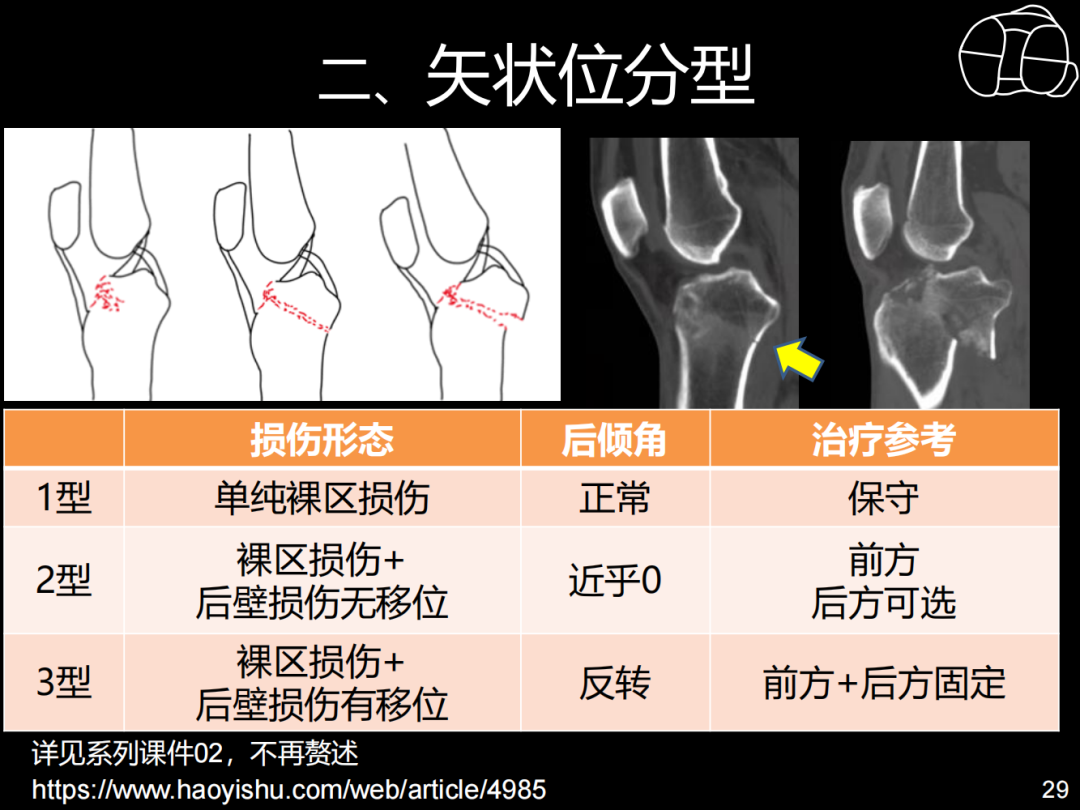 过伸型胫骨平台骨折