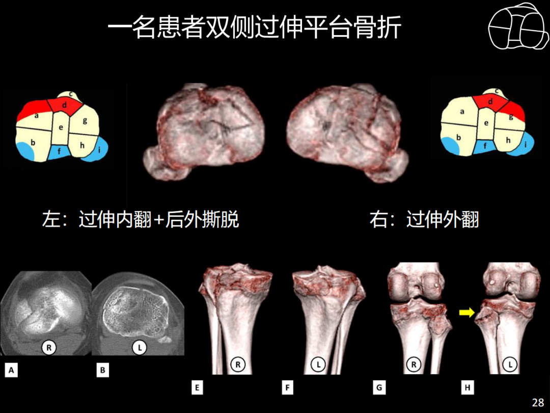 过伸型胫骨平台骨折