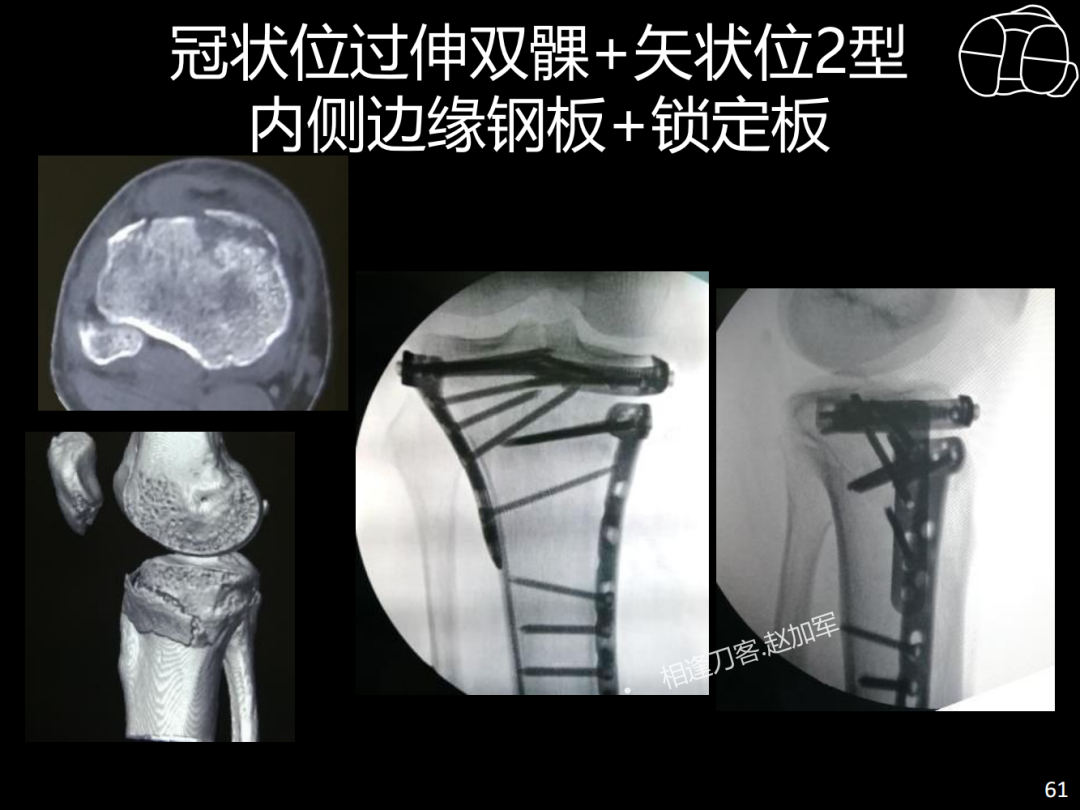 过伸型胫骨平台骨折