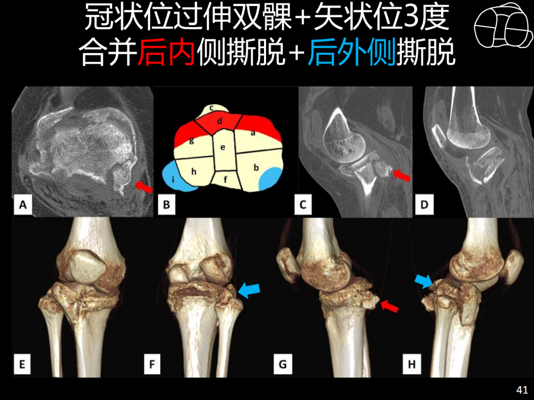 过伸型胫骨平台骨折